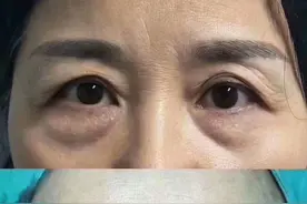 提眉手术给眼周带来多大变化，50岁姐姐来说说自己的“心路历程”图片