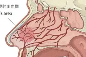 孩子为什么总是流鼻血？该怎么办？图片