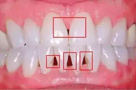 牙齿出现黑三角怎么办？真的是不可逆的吗？听听看牙医怎么说图片