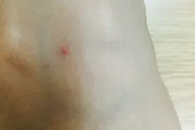 身上长出很多的小红痣，不痛不痒，意味着什么？图片
