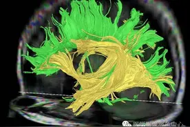 头颅磁共振（MRI）胼胝体纤维束三维DTI解剖--精品图集图片