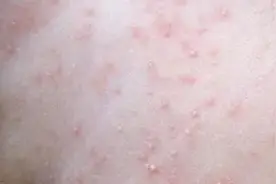 孩子身上最近起了红疙瘩，总忍不住想挠？可能是长痱子了图片