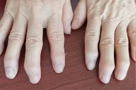 出现手指畸形，一定是得了类风湿关节炎吗？图片
