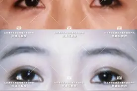 我适合哪种类型的双眼皮？图片