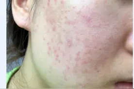 脸部过敏红痒怎么办？超级实用的6种小方法图片