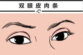 北大整形教授 | 双眼皮失败该如何修复？图片
