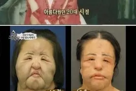 整容后遗症有多可怕？中美韩明星脸部塌房对比图，有些脸都认不出图片