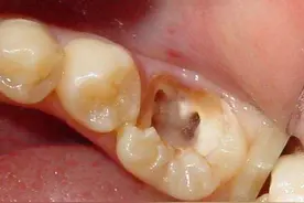老年人口内的残根残冠，怎么引起的？需要拔掉再修复吗？图片