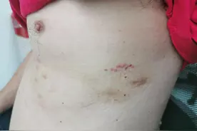 颊针治疗带状疱疹图片