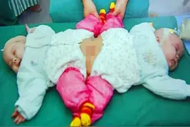 还记得那对“坐骨连体”双胞胎吗？姐妹俩已经11岁，身高差距很大图片