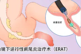 刘冰熔团队在内镜下逆行阑尾治疗术上取得创新性突破图片