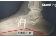 微型锁定接骨板与外固定支架治疗骰骨粉碎骨折的比较图片