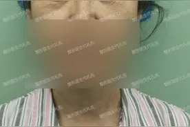 57岁眼周年轻化手术术前术后对比，公开6点细节感受图片