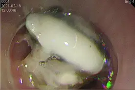 泉州男子误吞鸭骨头致消化道出血！医生：切忌用“土办法”处理图片