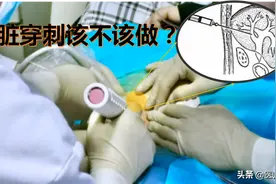 肝脏穿刺该不该做？风险高？医生给你全面详解图片