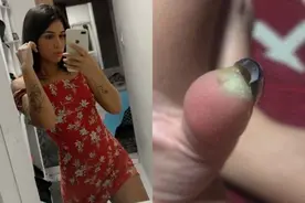 巴西妹子做美甲后拇指肿胀疼痛难忍，再去医院惨被截掉指尖图片
