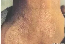 皮肤瘙痒难忍，小心神经性皮炎！图片