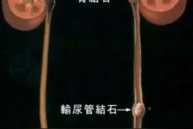 得了尿路结石，你应该知道的那些事儿呢？图片