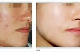 万年痘印去不掉？这样做，简单管用少花钱图片