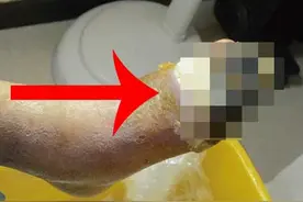 ​糖尿病足病脚趾头发黑什么原因怎么办图片