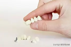 烤瓷牙出现牙龈黑线怎么办？图片