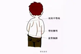 小孩有脊柱侧弯怎么办？图片