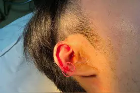 南昌一男子理发，耳朵被剪缝了4针！理发师答应赔偿又反悔了图片