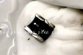 尴尬！广西男子将金属环套进下体，医生：不及时取出需切除图片