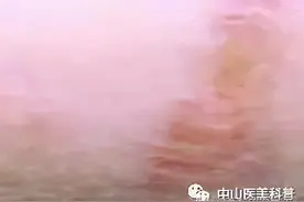 【爱美•科普】瘢痕不好看？可以治疗呀！图片