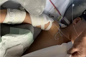 怎么下得了手？8岁女童被继父连砍4刀！三分之二的脊髓被切断，面临高位截瘫图片