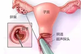 试管知识 | 穿刺取卵疼不疼，对身体有什么影响？图片
