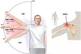 体能康复 | 肩峰撞击症的处理方法图片