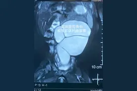 女婴长了“三个肾”输尿管扩张“粗如肠”泰安市妇幼保健院外三科医生微创技术来帮忙图片