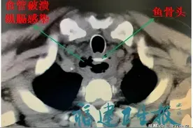厦门大叔误吞5厘米鱼骨头，一系列土方法自救让医生捉急！险些丧命图片