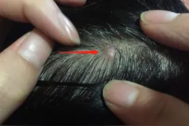 头皮上总“长痘痘”是咋回事？别用手抠，多半是这5种问题惹的祸图片