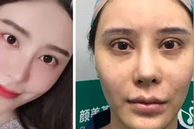 双眼皮修复主力军：网红欧式双眼皮，别人的天堂，我的地狱图片