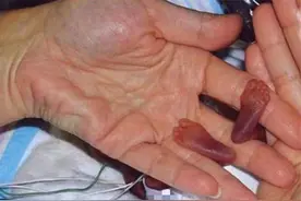 全球最小婴儿，体重只有280克，比巴掌还小，现状让很多人失望了图片