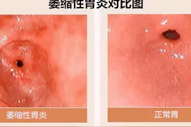 胃炎：拖着不治没关系，不慌不急我们十年后在肿瘤科见图片