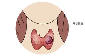 甲状腺癌变时，颈部会有4个变化，三类人群应注意，及时自查图片