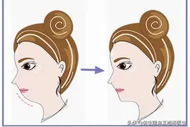 必看鼻部整形注意事项关键图片
