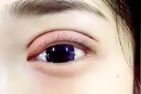 术后如何区别你是真性肉条还是假性肉条？图片