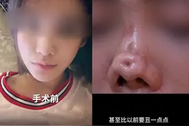 90后女主播整容失败，鼻梁塌陷还有坑画面吓人！哭诉被医院坑惨图片