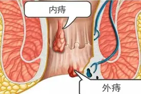 不疼的痔叫内痔，当它脱出肛门外时，就只剩这种办法能帮到你了图片