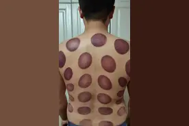 昨天在清水瓦台拔火罐，后背简直惨不忍睹图片