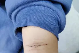广东17岁抑郁女孩用剪刀自残，专家提醒：警惕冬季抑郁症高发图片