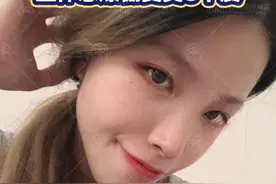 做完宽鼻矫正+半肋隆鼻1个月，立体感爆棚变美5个度图片