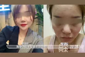 女子整形后鼻子歪了 院方：肋骨还有，可以修复！|解忧帮图片
