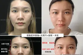 一块骨头把温柔脸变凶脸？她颧骨高如山，不经磨骨之痛却收获了美图片