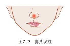 「观面无隐私」鼻色异常，可能得了梅毒图片