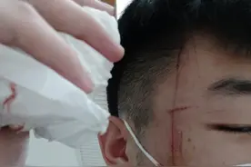 小伙经过西安民乐园万达公寓遭遇天降横祸，掉落瓷片直接砸到脸上图片